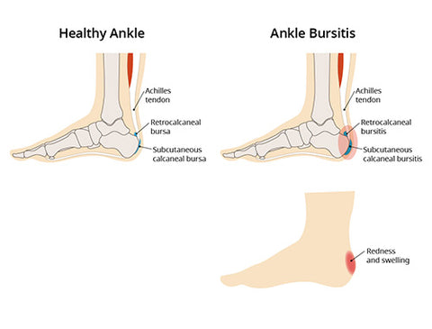 Your Heel Spur Is Not Your Problem | Busting heel pain myths